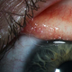 Ojo de Abby Beckley con el gusano. Imagen: John Hoyt
